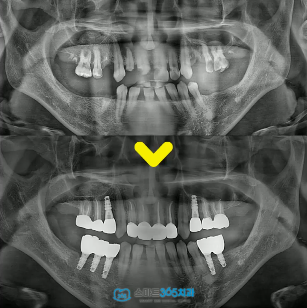 창원임플란트추천